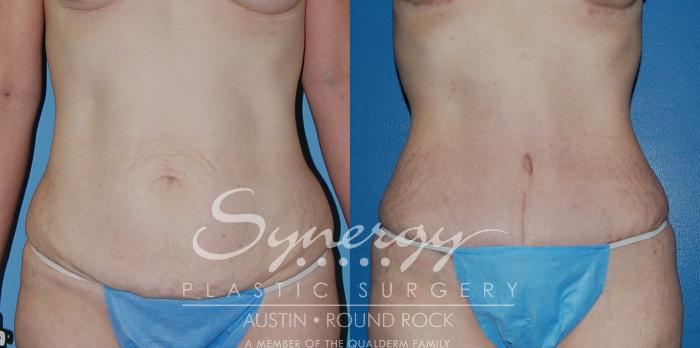 Before & After Abdominoplasty (Tummy Tuck) Case 13 View #2 View in Austin, TX