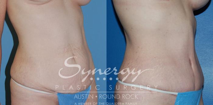 Before & After Abdominoplasty (Tummy Tuck) Case 13 View #3 View in Austin, TX