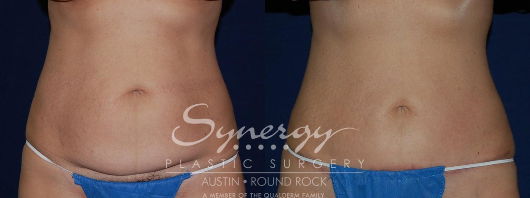 Before & After Abdominoplasty (Tummy Tuck) Case 138 View #1 View in Austin, TX