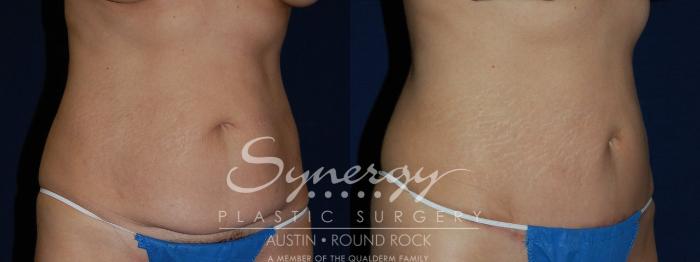Before & After Abdominoplasty (Tummy Tuck) Case 138 View #2 View in Austin, TX