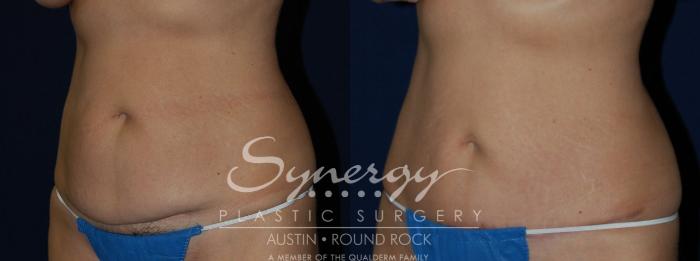 Before & After Abdominoplasty (Tummy Tuck) Case 138 View #3 View in Austin, TX