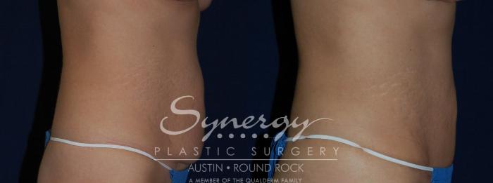 Before & After Abdominoplasty (Tummy Tuck) Case 138 View #4 View in Austin, TX