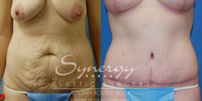 Before & After Abdominoplasty (Tummy Tuck) Case 14 View #1 View in Austin, TX