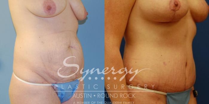 Before & After Abdominoplasty (Tummy Tuck) Case 14 View #2 View in Austin, TX
