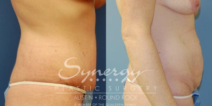 Before & After Abdominoplasty (Tummy Tuck) Case 14 View #3 View in Austin, TX