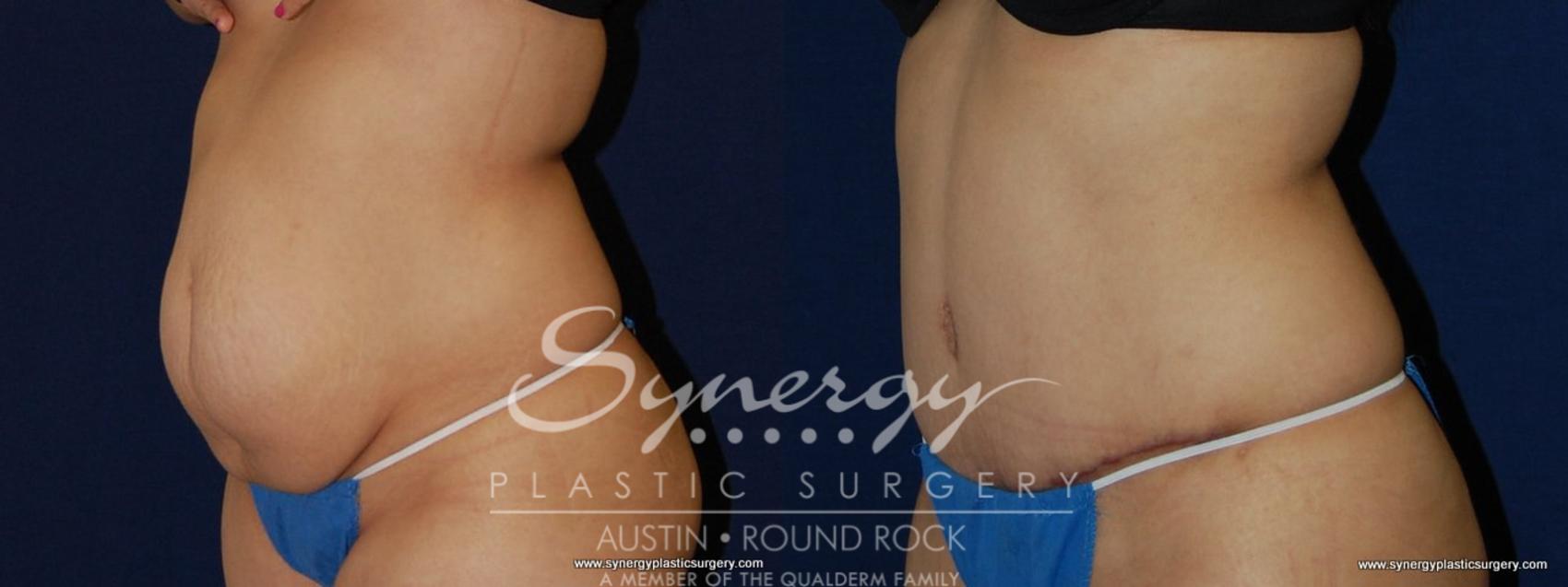 Before & After Abdominoplasty (Tummy Tuck) Case 148 View #1 View in Austin, TX