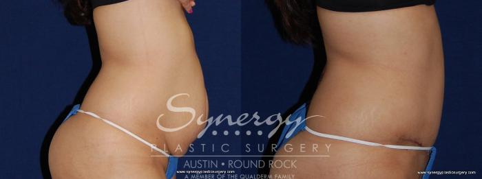 Before & After Abdominoplasty (Tummy Tuck) Case 148 View #2 View in Austin, TX