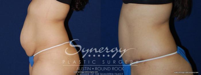 Before & After Abdominoplasty (Tummy Tuck) Case 148 View #3 View in Austin, TX