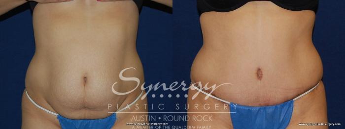 Before & After Abdominoplasty (Tummy Tuck) Case 148 View #4 View in Austin, TX