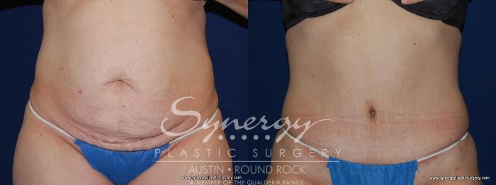 Before & After Abdominoplasty (Tummy Tuck) Case 149 View #2 View in Austin, TX
