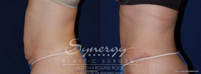 Before & After Abdominoplasty (Tummy Tuck) Case 149 View #3 View in Austin, TX