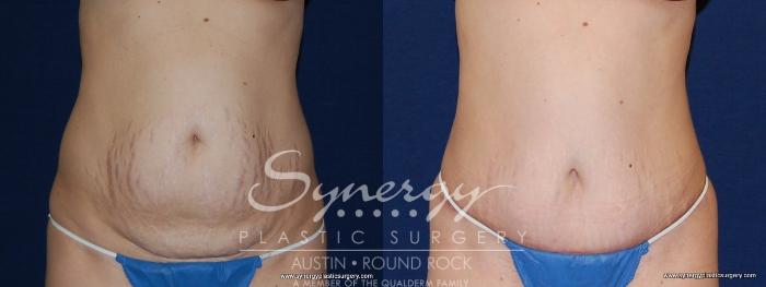 Before & After Abdominoplasty (Tummy Tuck) Case 152 View #1 View in Austin, TX
