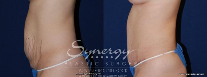 Before & After Abdominoplasty (Tummy Tuck) Case 152 View #2 View in Austin, TX