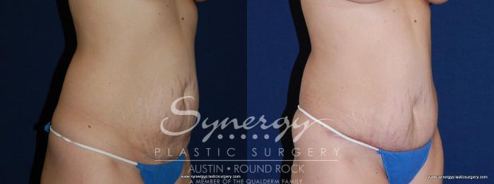 Before & After Abdominoplasty (Tummy Tuck) Case 152 View #3 View in Austin, TX