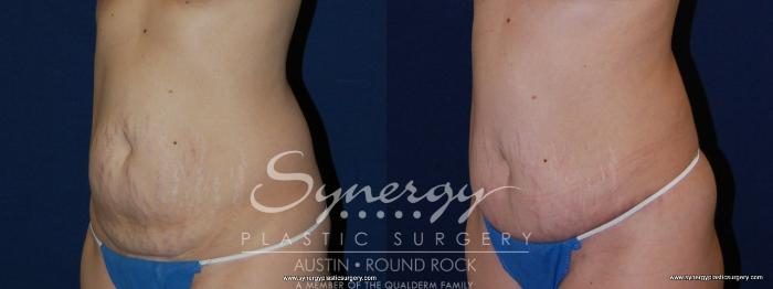 Before & After Abdominoplasty (Tummy Tuck) Case 152 View #4 View in Austin, TX