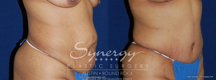 Before & After Abdominoplasty (Tummy Tuck) Case 156 View #3 View in Austin, TX