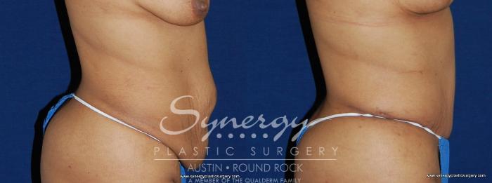Before & After Abdominoplasty (Tummy Tuck) Case 156 View #4 View in Austin, TX