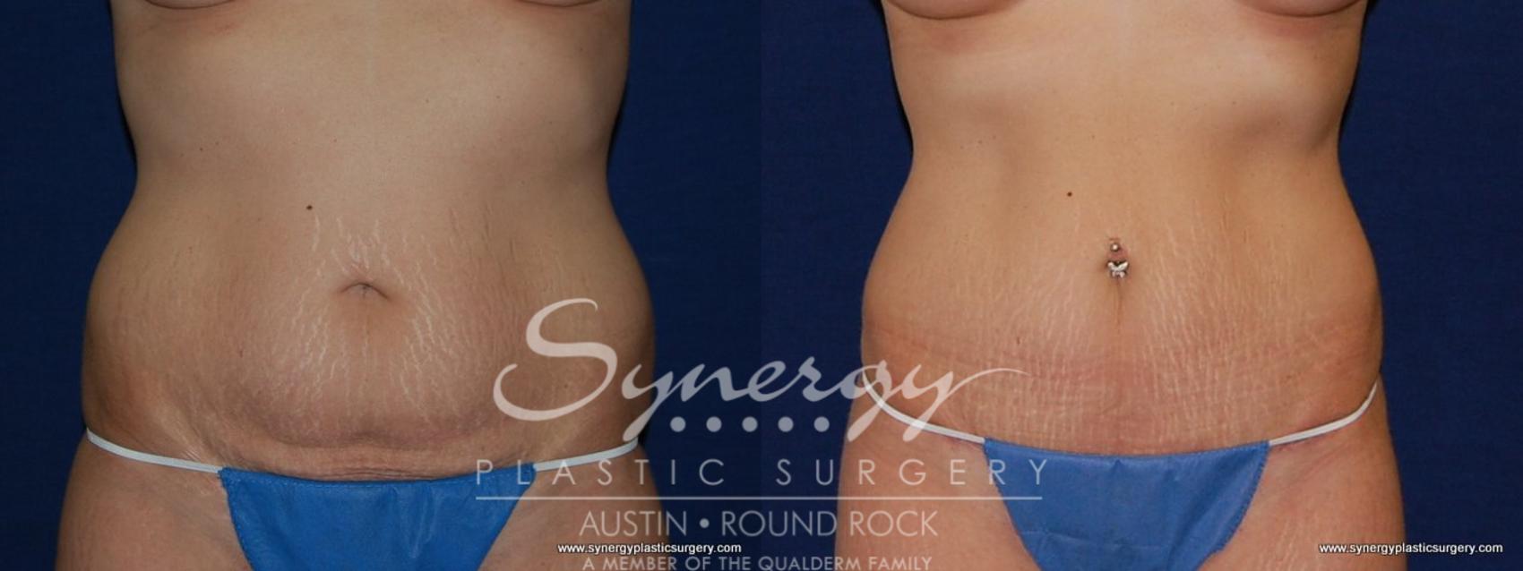 Before & After Abdominoplasty (Tummy Tuck) Case 179 View #1 View in Austin, TX