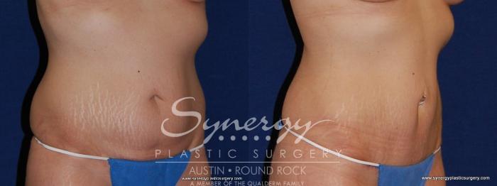 Before & After Abdominoplasty (Tummy Tuck) Case 179 View #2 View in Austin, TX