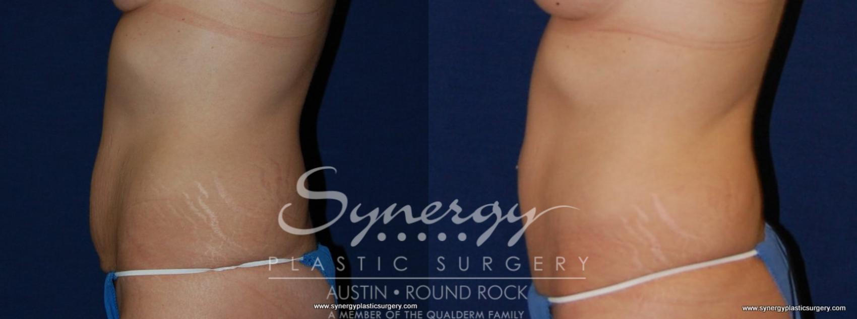 Before & After Abdominoplasty (Tummy Tuck) Case 179 View #3 View in Austin, TX