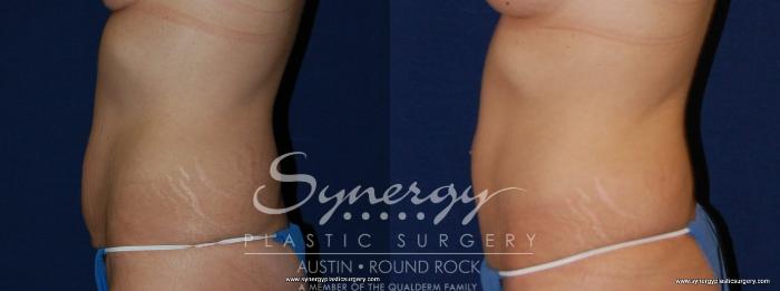 Before & After Abdominoplasty (Tummy Tuck) Case 179 View #3 View in Austin, TX