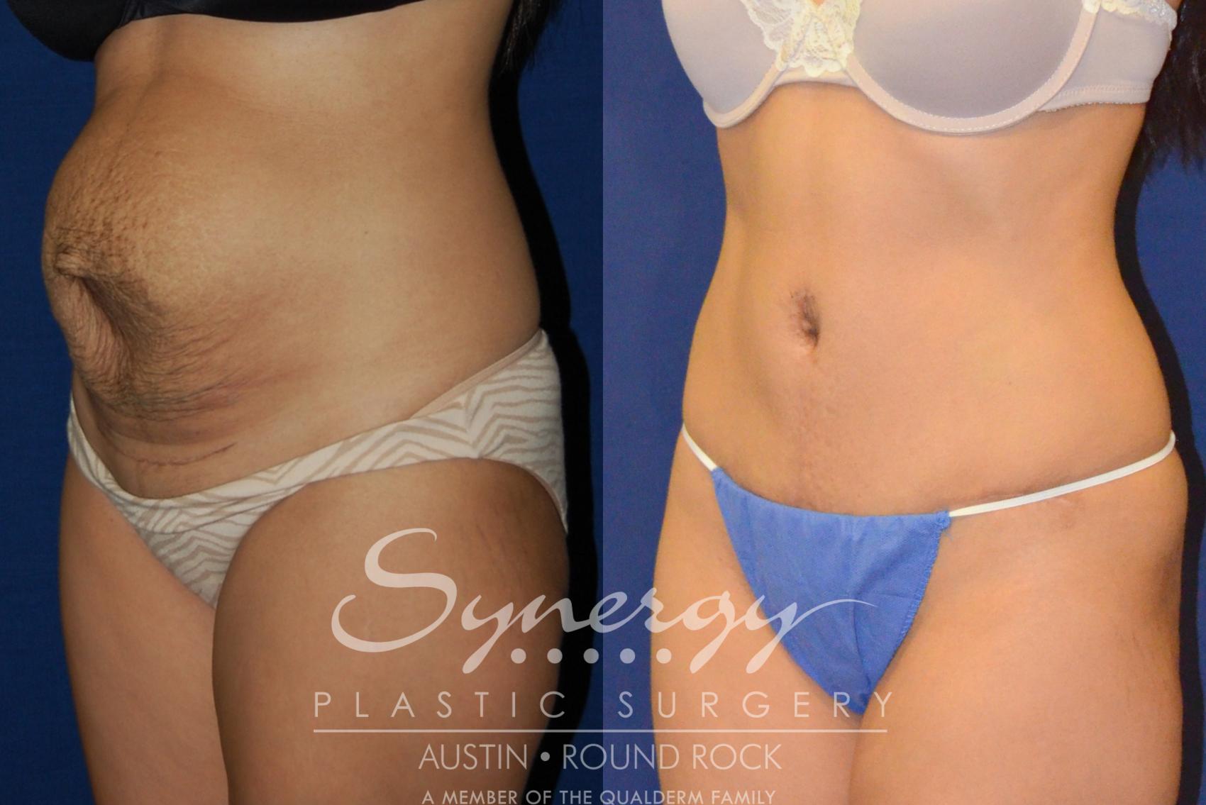 Before & After Abdominoplasty (Tummy Tuck) Case 205 View #1 View in Austin, TX