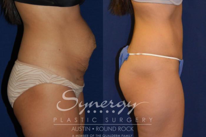 Before & After Abdominoplasty (Tummy Tuck) Case 205 View #2 View in Austin, TX
