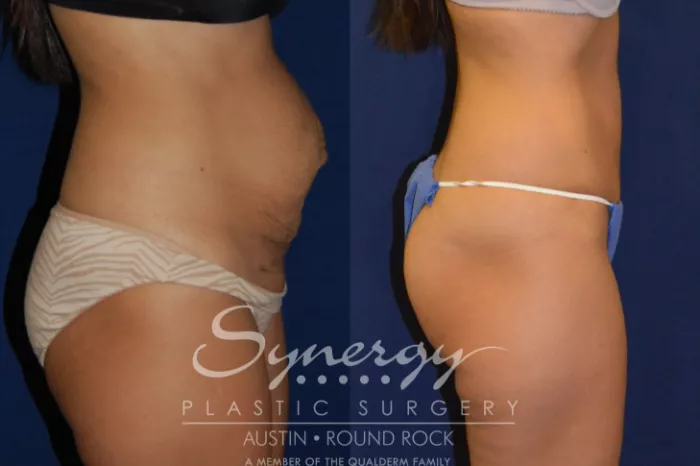 How Long After a Tummy Tuck Can You Wear Jeans, Drive, Exercise? – Austin,  TX – Synergy Plastic Surgery