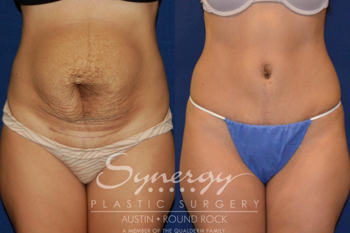 Before & After Abdominoplasty (Tummy Tuck) Case 205 View #3 View in Austin, TX