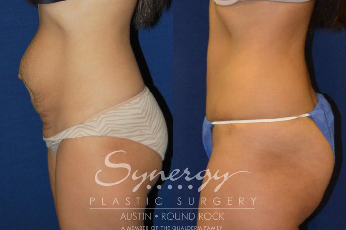 Before & After Abdominoplasty (Tummy Tuck) Case 205 View #4 View in Austin, TX