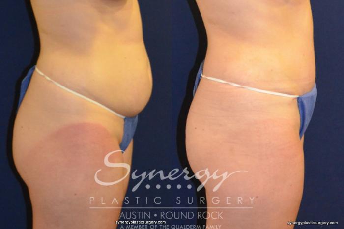 Before & After Abdominoplasty (Tummy Tuck) Case 216 View #1 View in Austin, TX