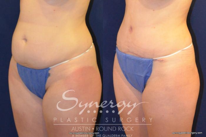 Before & After Abdominoplasty (Tummy Tuck) Case 216 View #2 View in Austin, TX