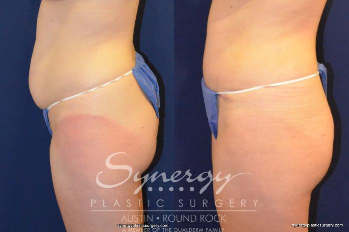 Before & After Abdominoplasty (Tummy Tuck) Case 216 View #3 View in Austin, TX