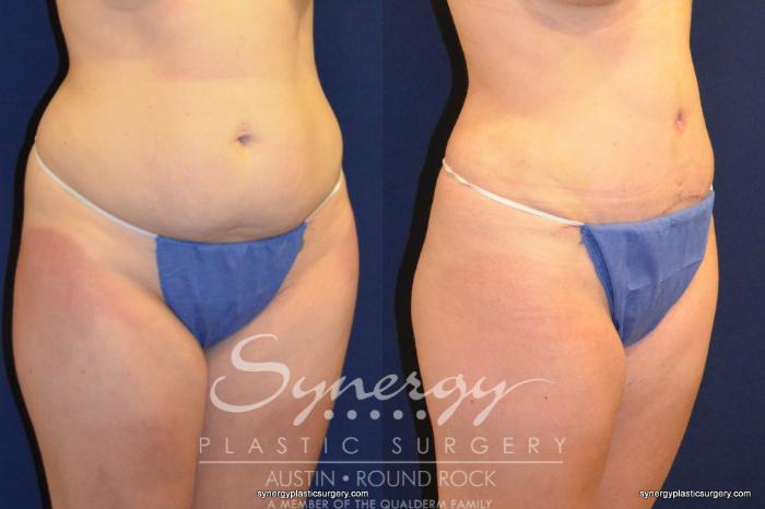 Before & After Abdominoplasty (Tummy Tuck) Case 216 View #4 View in Austin, TX