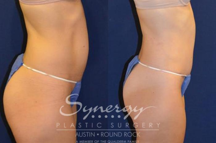 Before & After Abdominoplasty (Tummy Tuck) Case 217 View #1 View in Austin, TX