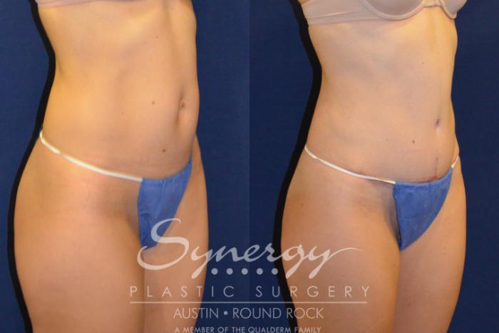 Before & After Abdominoplasty (Tummy Tuck) Case 217 View #2 View in Austin, TX