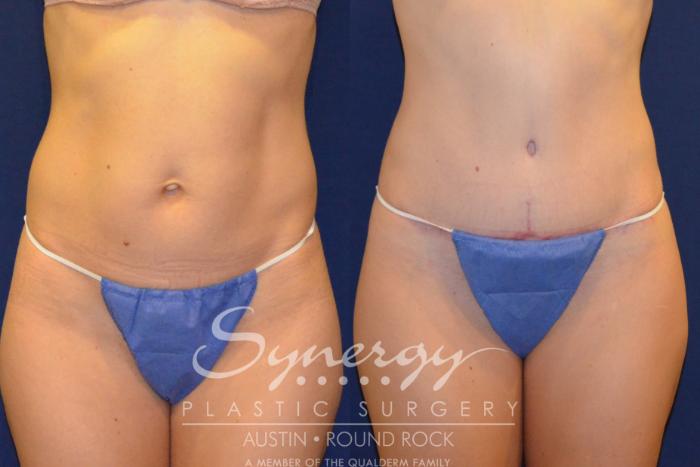 Before & After Abdominoplasty (Tummy Tuck) Case 217 View #3 View in Austin, TX