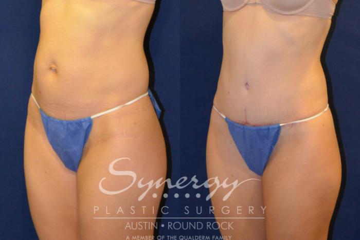 Before & After Abdominoplasty (Tummy Tuck) Case 217 View #4 View in Austin, TX