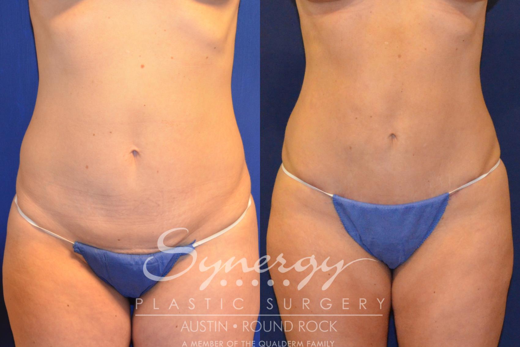 Before & After Abdominoplasty (Tummy Tuck) Case 223 View #1 View in Austin, TX