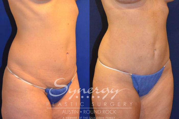 Before & After Abdominoplasty (Tummy Tuck) Case 223 View #2 View in Austin, TX