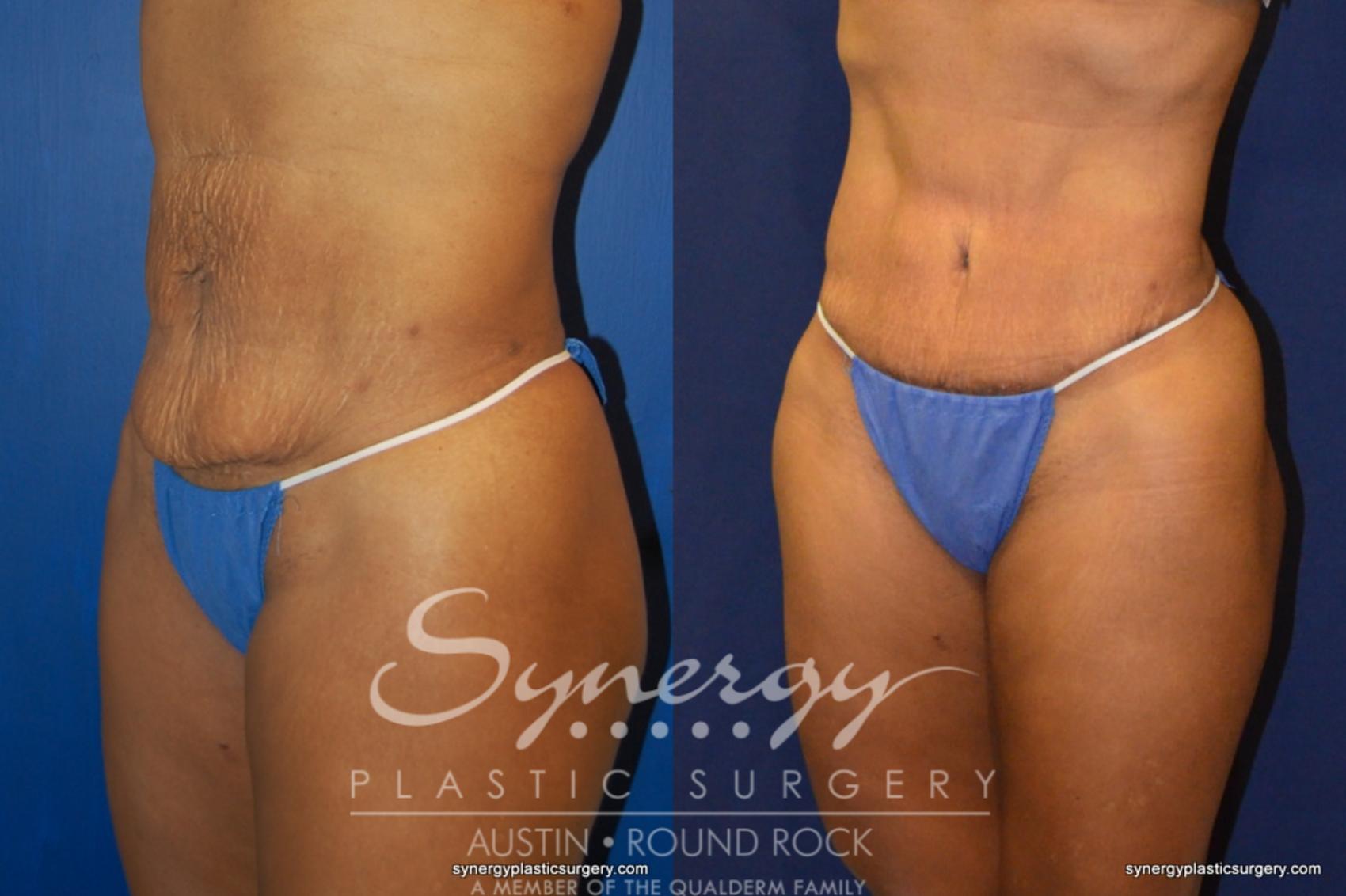 Before & After Abdominoplasty (Tummy Tuck) Case 229 View #1 View in Austin, TX