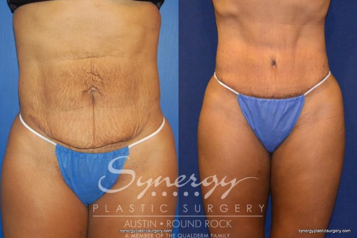 Before & After Abdominoplasty (Tummy Tuck) Case 229 View #2 View in Austin, TX