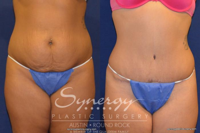 Before & After Abdominoplasty (Tummy Tuck) Case 230 View #1 View in Austin, TX
