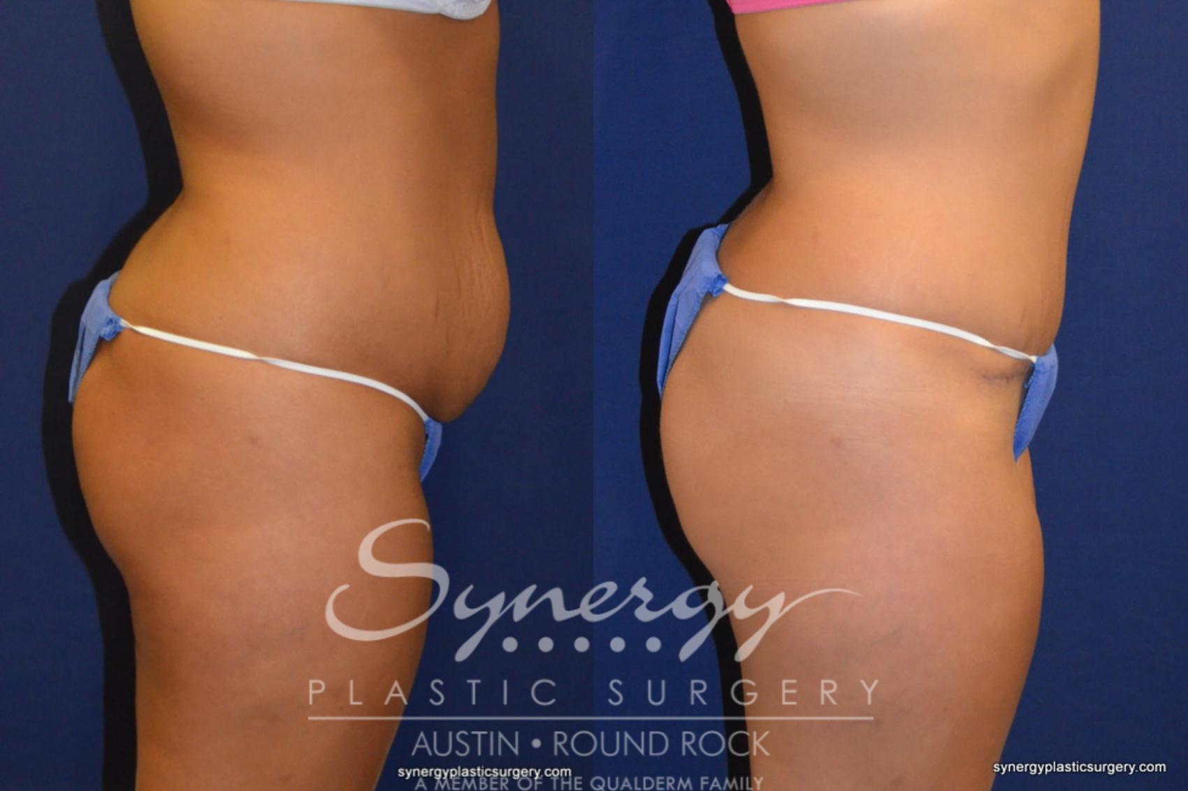 Before & After Abdominoplasty (Tummy Tuck) Case 230 View #2 View in Round Rock, TX