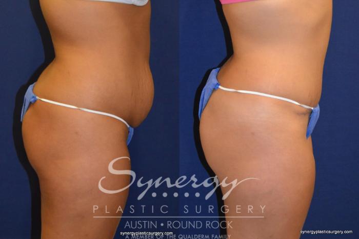 Before & After Abdominoplasty (Tummy Tuck) Case 230 View #2 View in Austin, TX