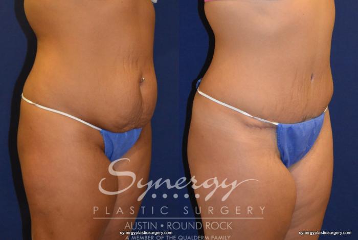 Before & After Abdominoplasty (Tummy Tuck) Case 230 View #3 View in Austin, TX