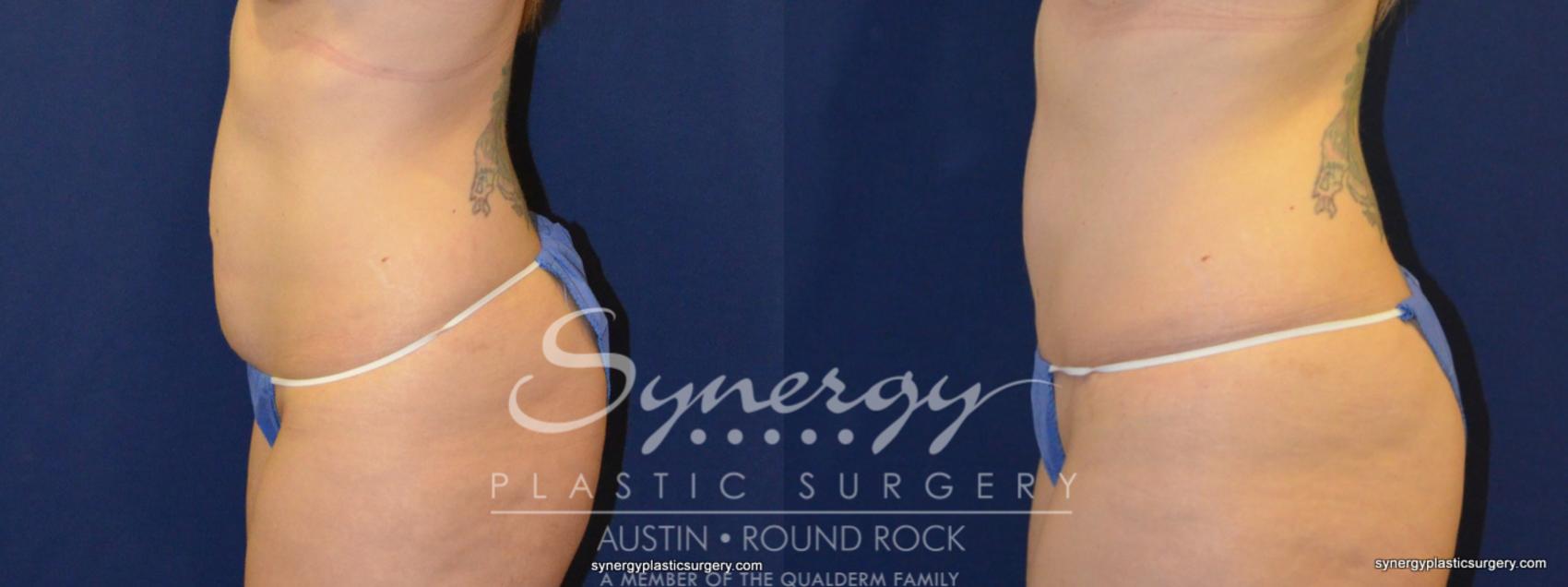 Before & After Abdominoplasty (Tummy Tuck) Case 232 View #1 View in Austin, TX