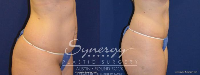 Before & After Abdominoplasty (Tummy Tuck) Case 232 View #2 View in Austin, TX