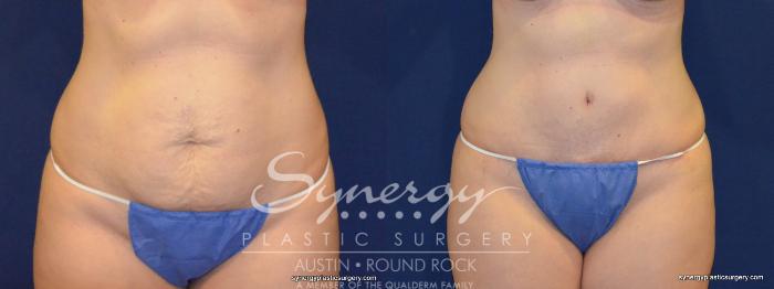 Before & After Abdominoplasty (Tummy Tuck) Case 232 View #3 View in Austin, TX