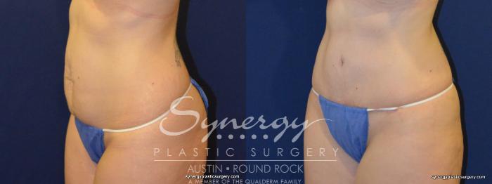 Before & After Abdominoplasty (Tummy Tuck) Case 232 View #4 View in Austin, TX